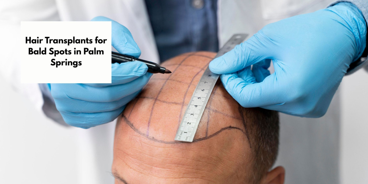 Hair Transplants for Bald Spots in Palm Springs