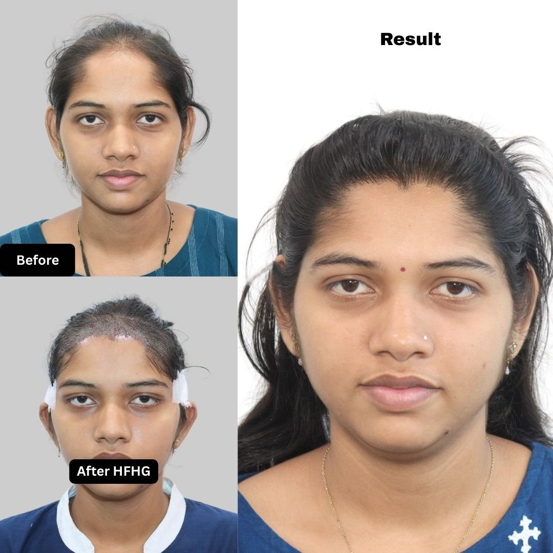 Best Female Hair Transplant in Pune | Dr. Kiran Chotaliya